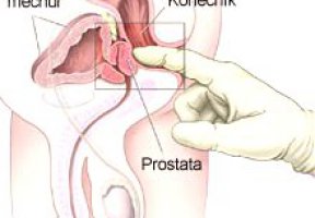 Masáž prostaty: